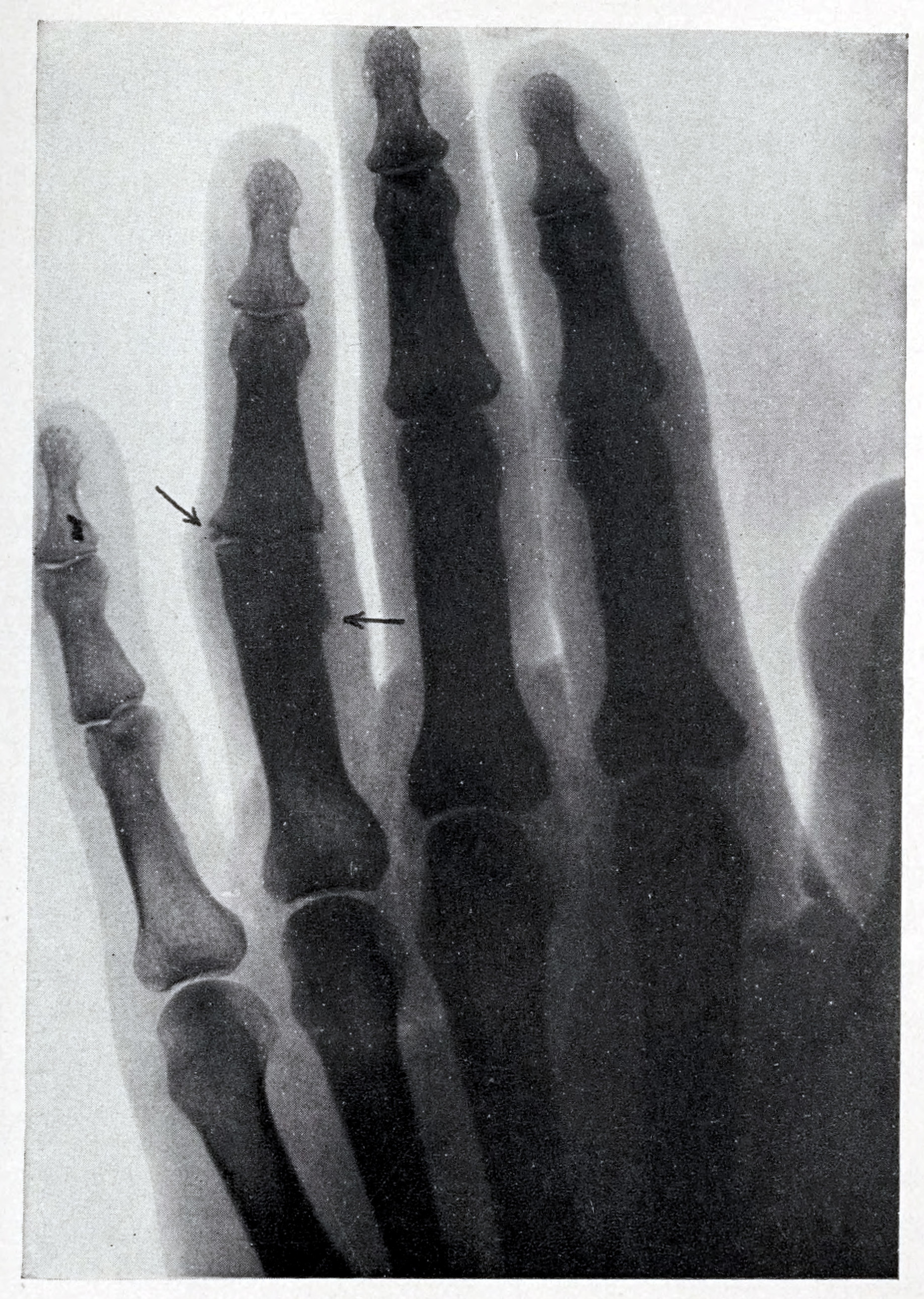 An X-Ray Photograph of the hand taken with the Outfit shown in Figure 174.